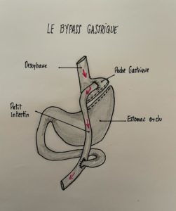 Le Bypass gastrique