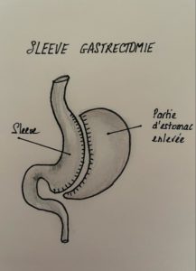 La Sleeve gastrectomie